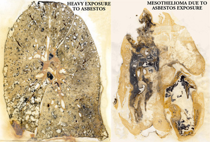 Mesothelioma due to asbestos exposure